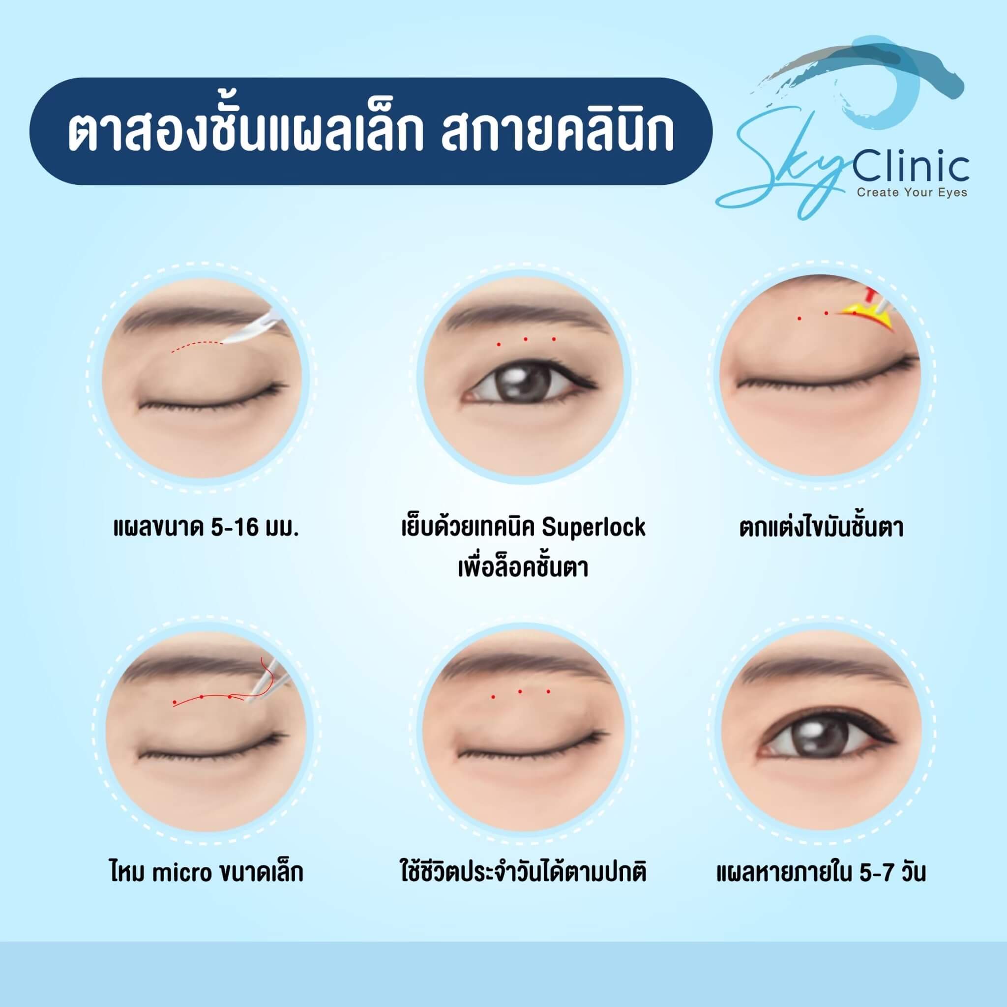 ทำตาสองชั้น กรีดยาวแผลเล็ก - Sky Clinic ทำตาสองชั้น หมอสกาย โดย จักษุแพทย์