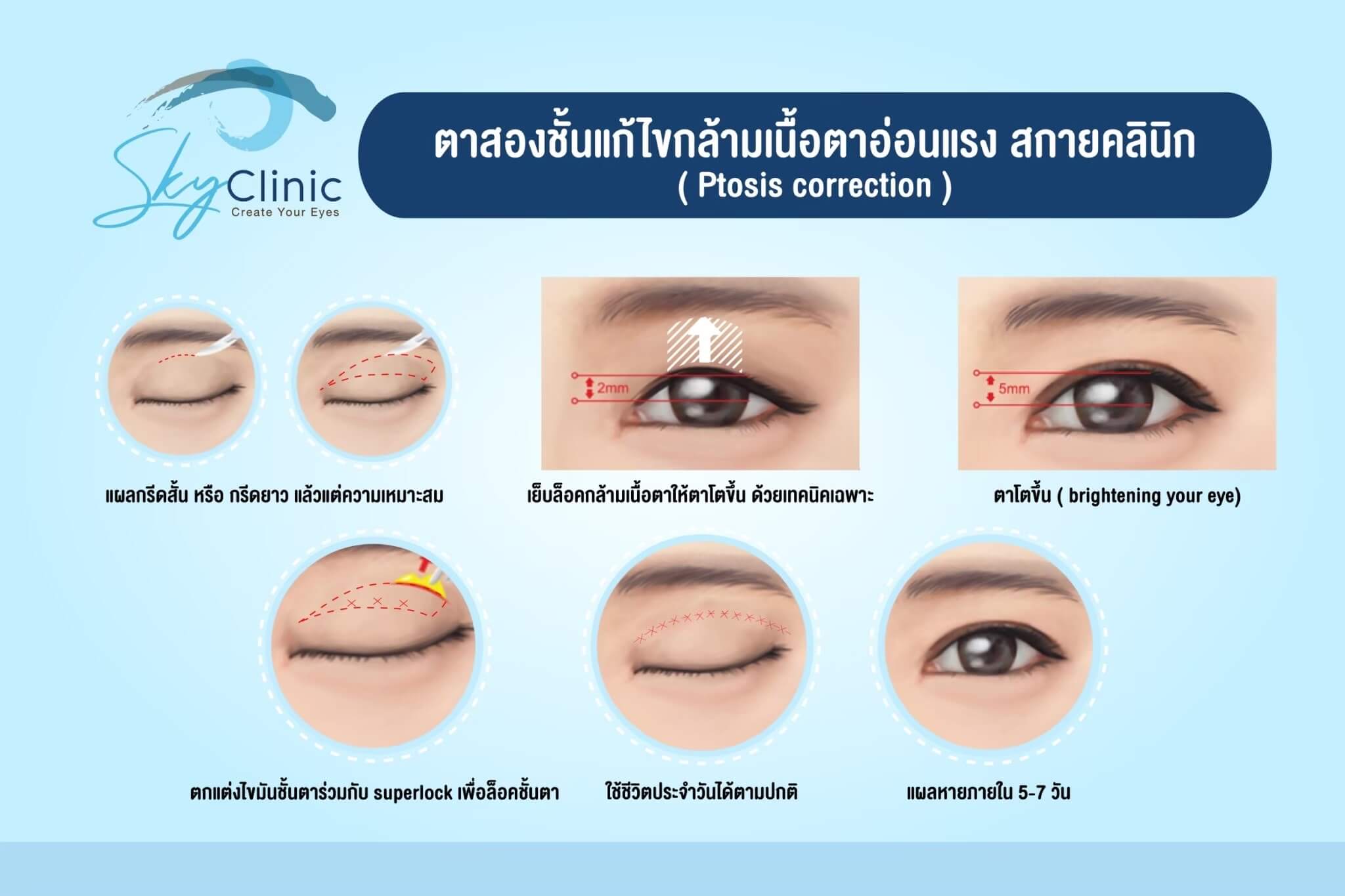 Reduce belly to not sagged and not pendulous.  ทำตาสองชั้น เปิด