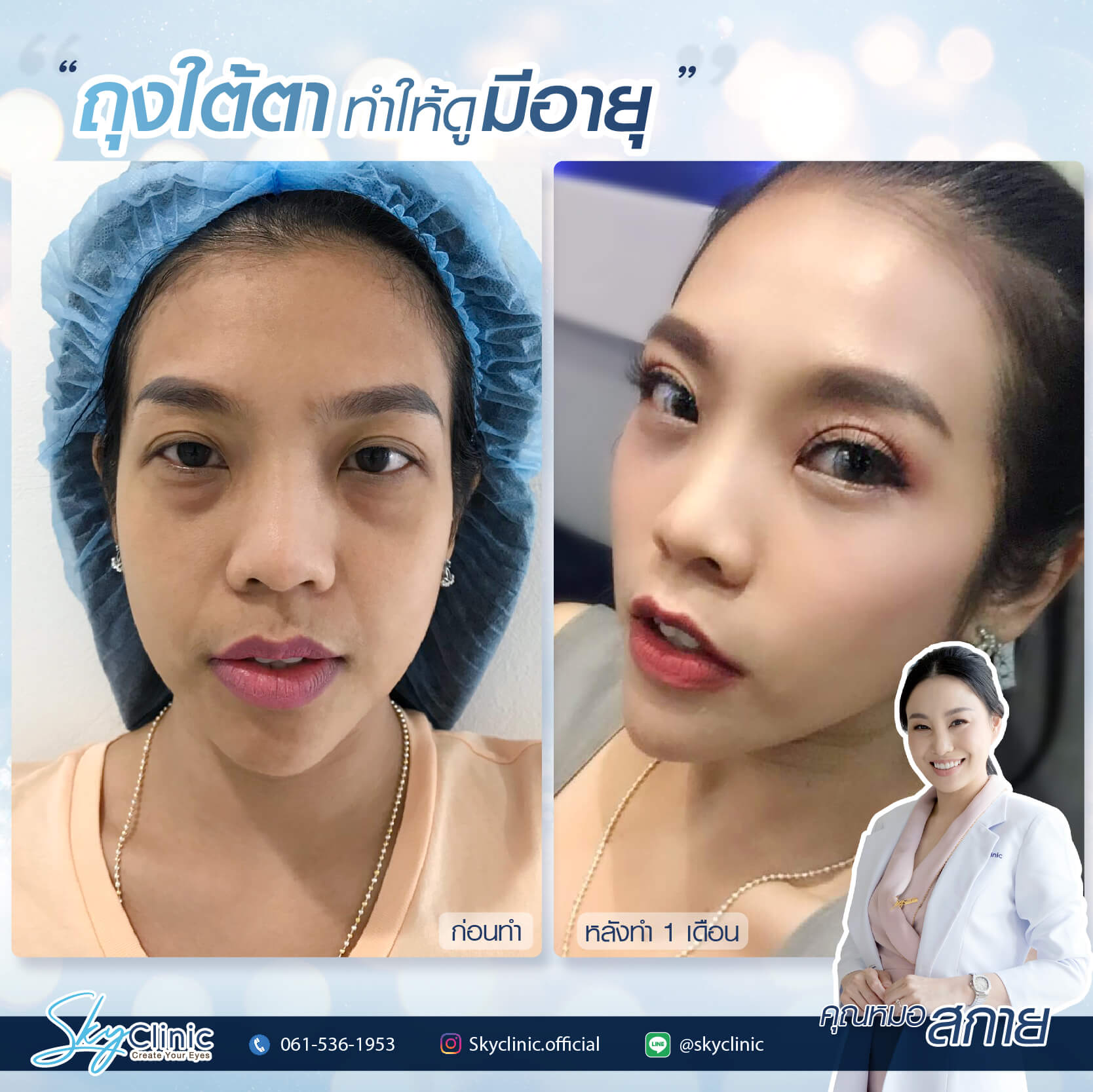 กำจัดและจัดเรียงไขมันตาล่าง (Under eye fat removal and reposition)